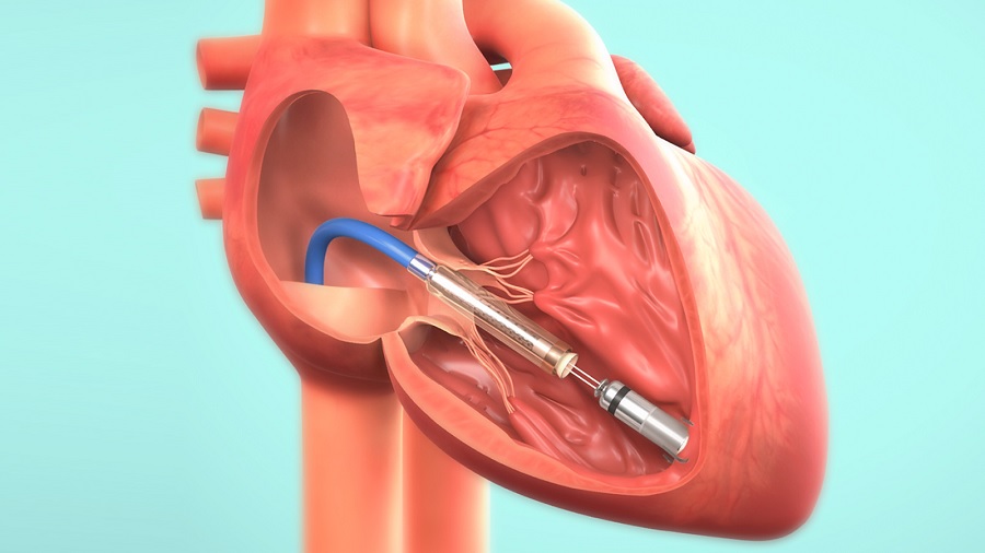Al Fatebenefratelli per la prima volta l’impianto dello straordinario dispositivo pacemaker bicamerale invisibile