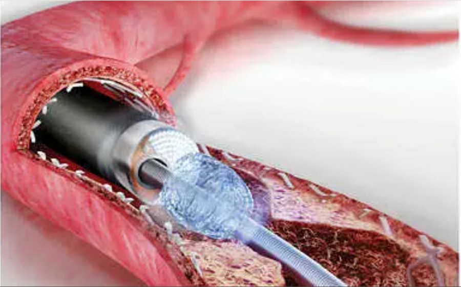 Laser intra-coronarico per PTCA complesse: primo caso al Fatebenefratelli